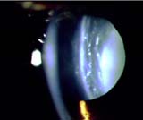 catarata por corticoide