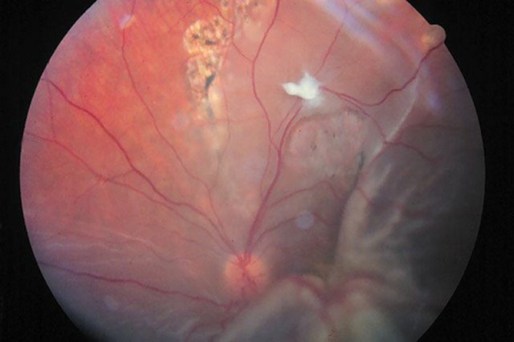 Descolamento de retina tracional
